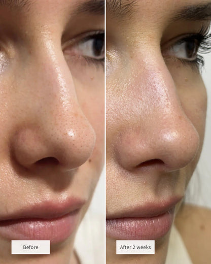 Vue™ Hydrocolloid Nose Patches