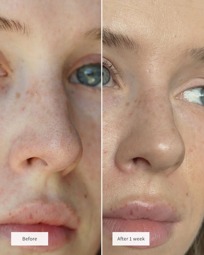 Vue™ Hydrocolloid Nose Patches