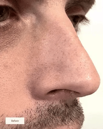 Vue™ Hydrocolloid Nose Patches